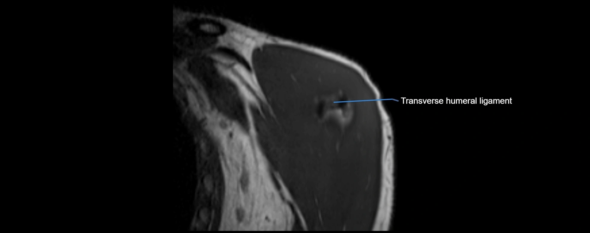 shoulder ligments coronal  cross sectional anatomy 3T MRI AI enhanced radiology image -img-00001-00002.webp